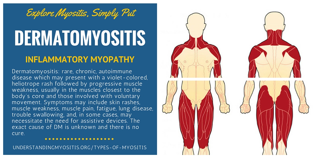 Dermatomyositis